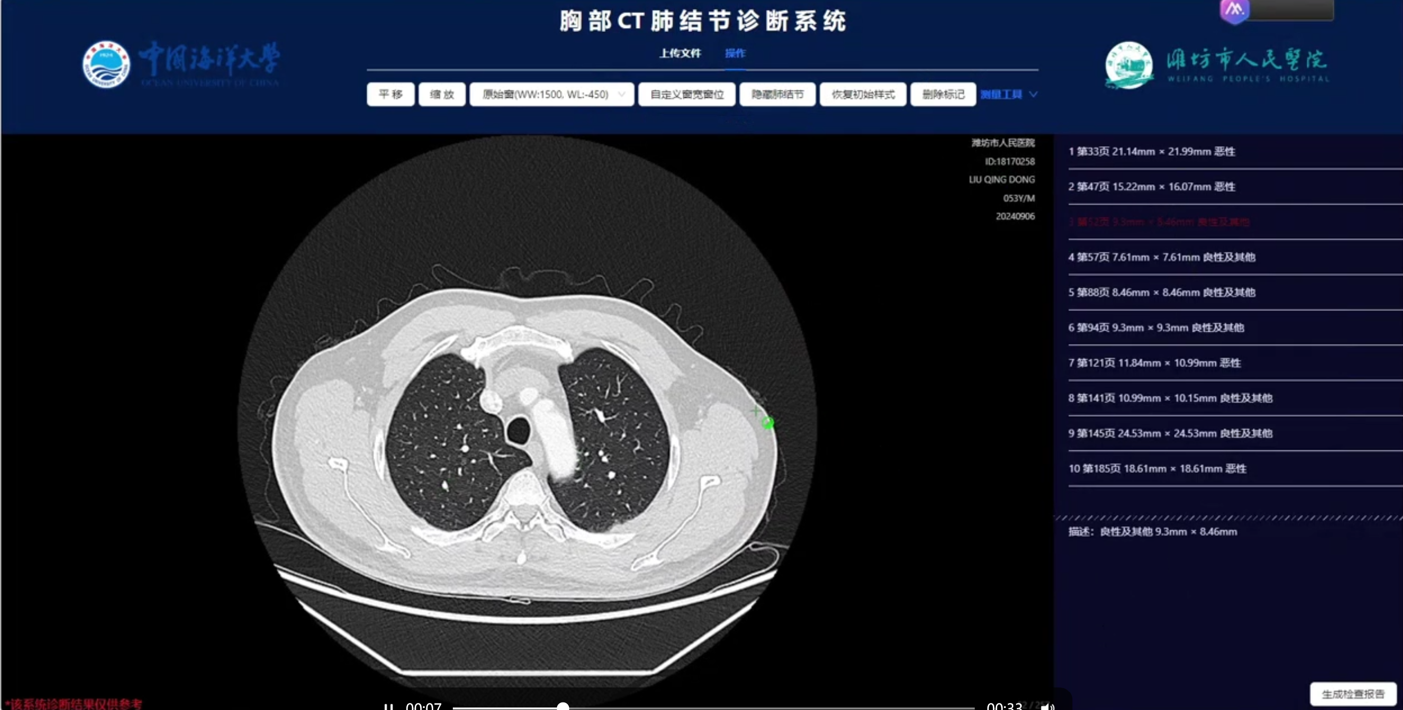 胸部CT肺结节诊断系统